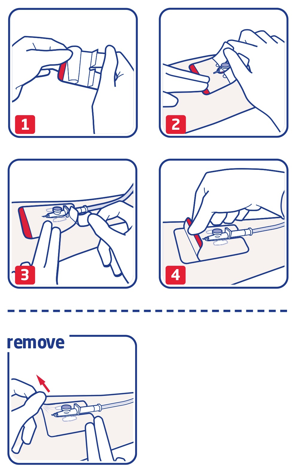 How to use Leukomed IV film by Leukoplast How to use Leukomed IV film by Leukoplast